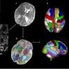 Pokazuje skany mózgu w okresie okołoporodowym z zaznaczeniem obszarów związanych z autyzmem