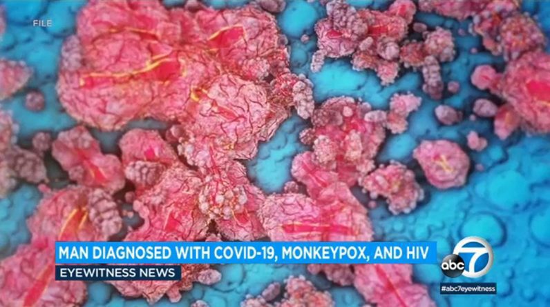 U mężczyzny zdiagnozowano jednocześnie ospę małp, COVID-19 i HIV